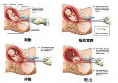 药物流产后没干净怎么办?药流后两点注意事项