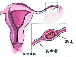 输卵管病变引起宫外孕