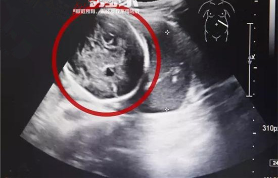 怀胎6月子宫竟然空了，孩子突然不见了?结局吓得一身冷汗！