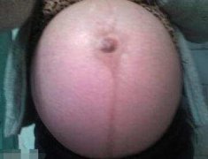 孕妇肚子巨大，疑似怀了双胞胎，剖开肚子后惊呆了..
