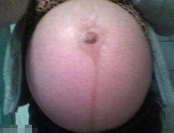 孕妇肚子巨大,疑似怀了双胞胎,医生剖开肚子后惊呆了..