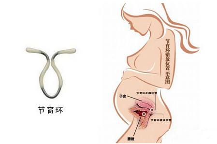 取环可以立即上环吗？医生给出这样的建议..