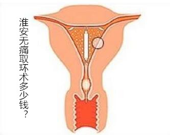 淮安***取环术多少钱？对自己负责：挑选诚信医院，准没错！