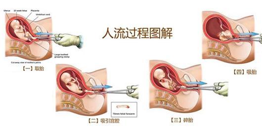***人流过程_5个人流步骤_揭秘***人流手术过程的感觉!