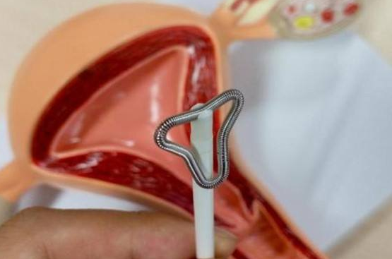 淮安上环多少钱一个?【注意】医生说这个时候上更合适